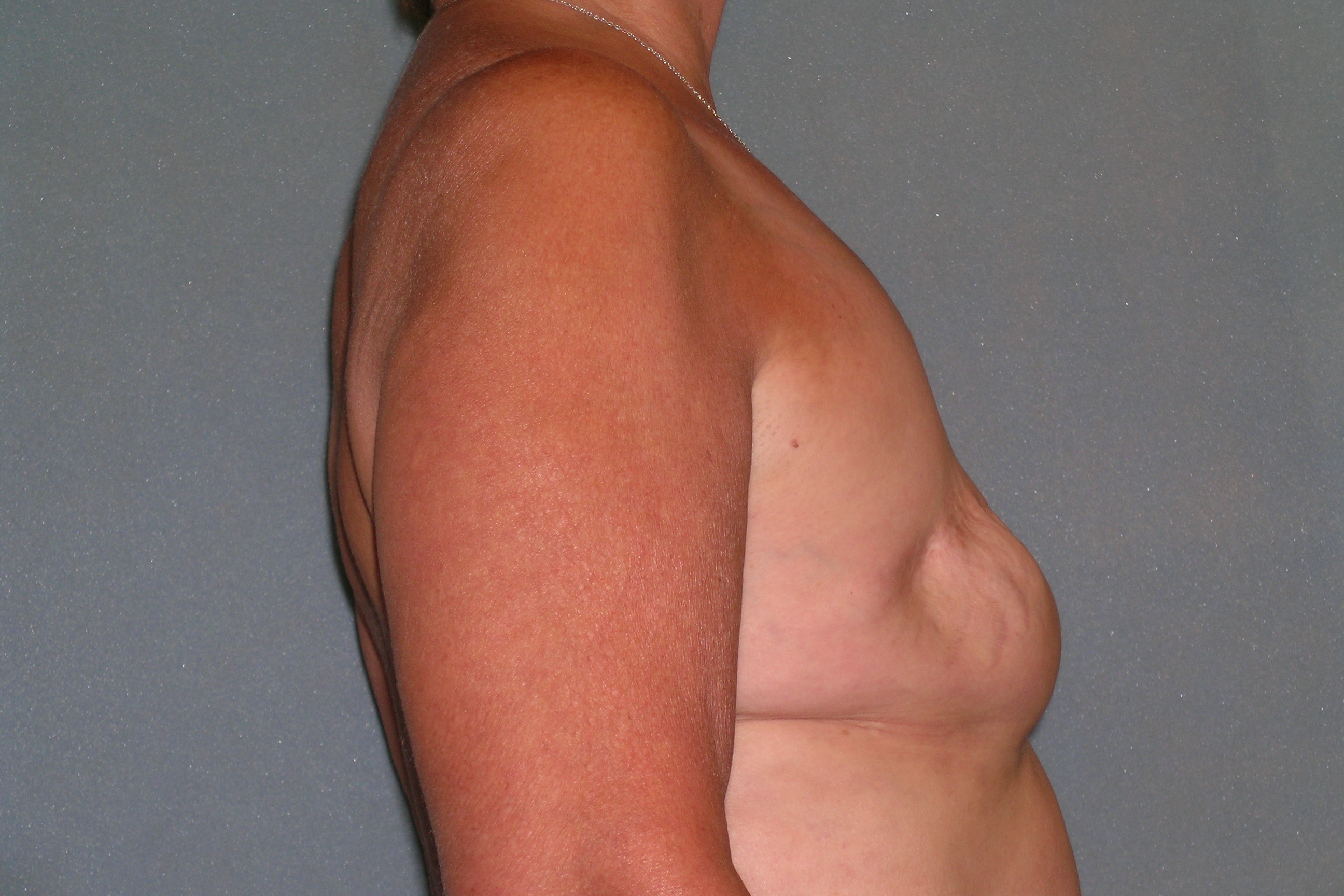 Breast Reconstruction Before and After Photos