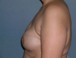 Breast Reconstruction
