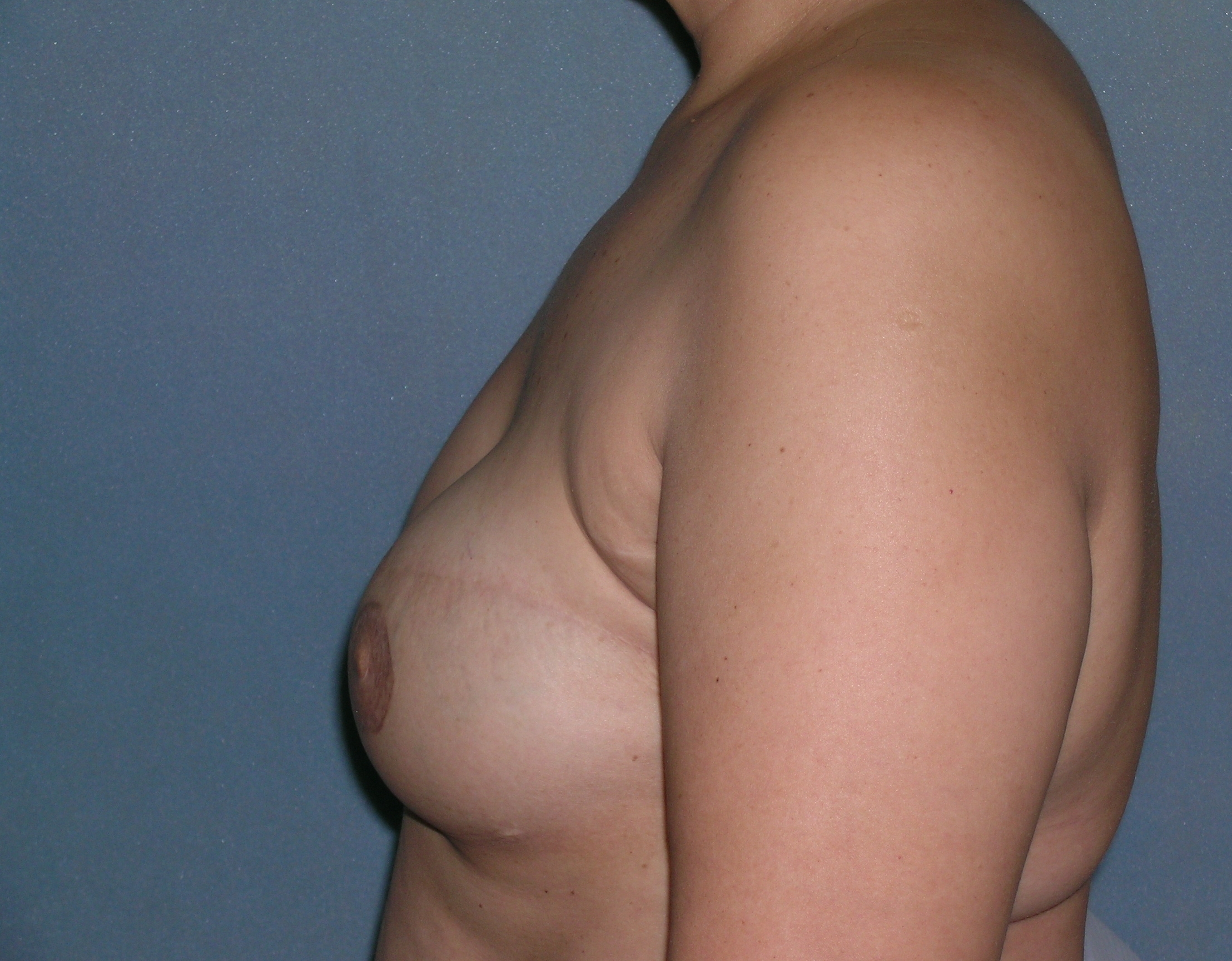 Breast Reconstruction Before and After Photos