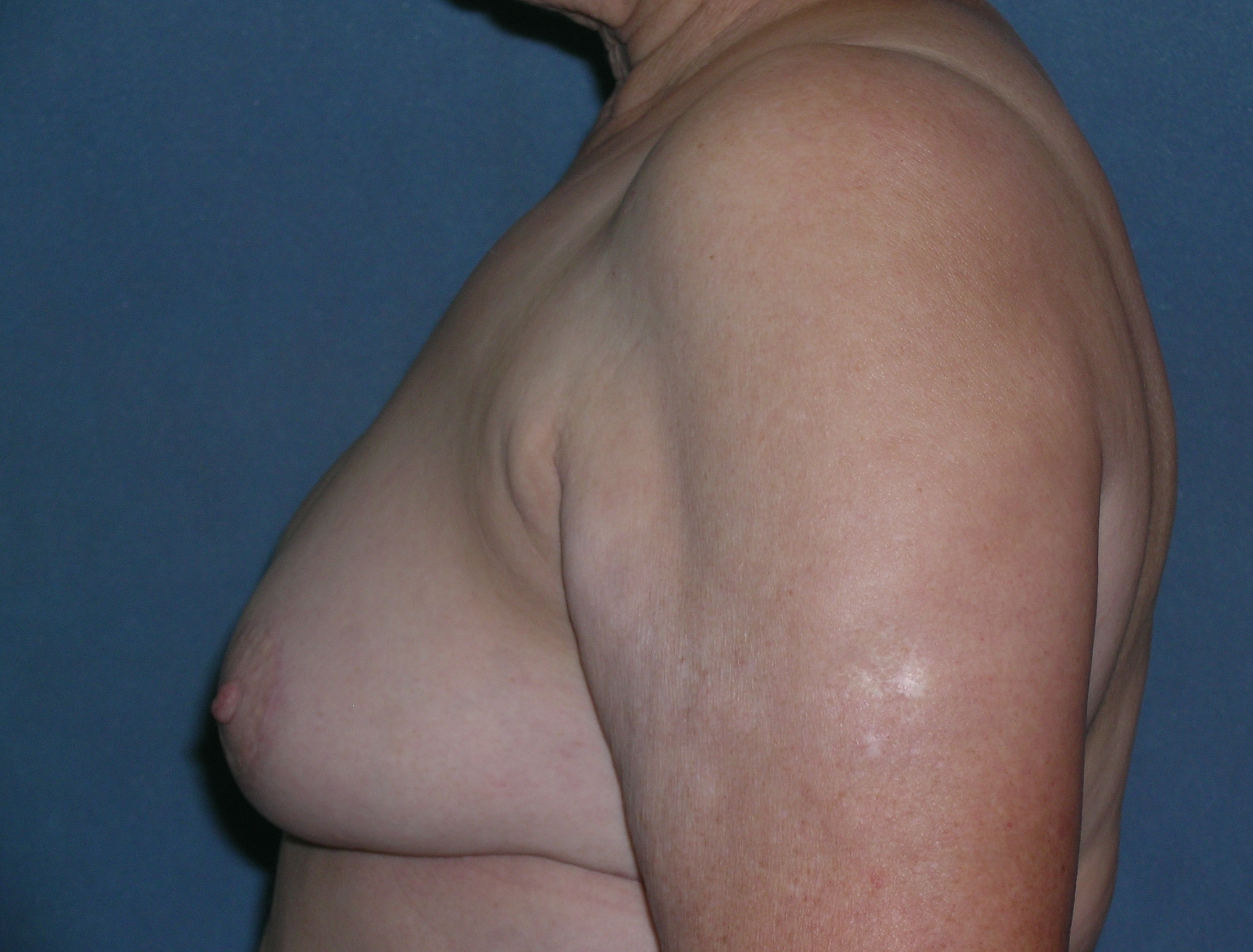 Breast Reconstruction Before and After Photos