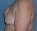 Breast Reconstruction