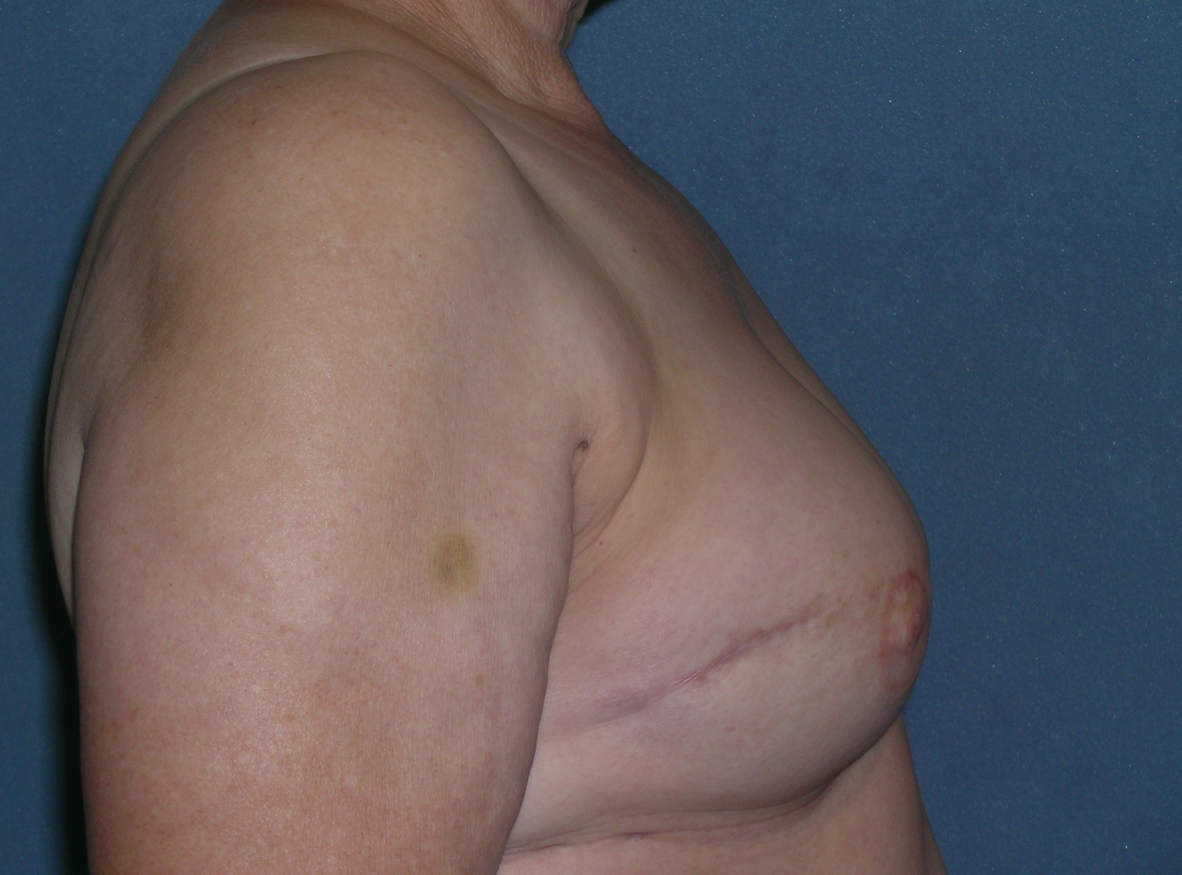 Breast Reconstruction Before and After Photos