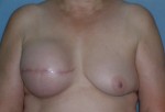 Breast Reconstruction