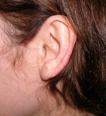 Otoplasty