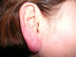 Otoplasty