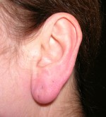 Otoplasty