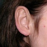Otoplasty