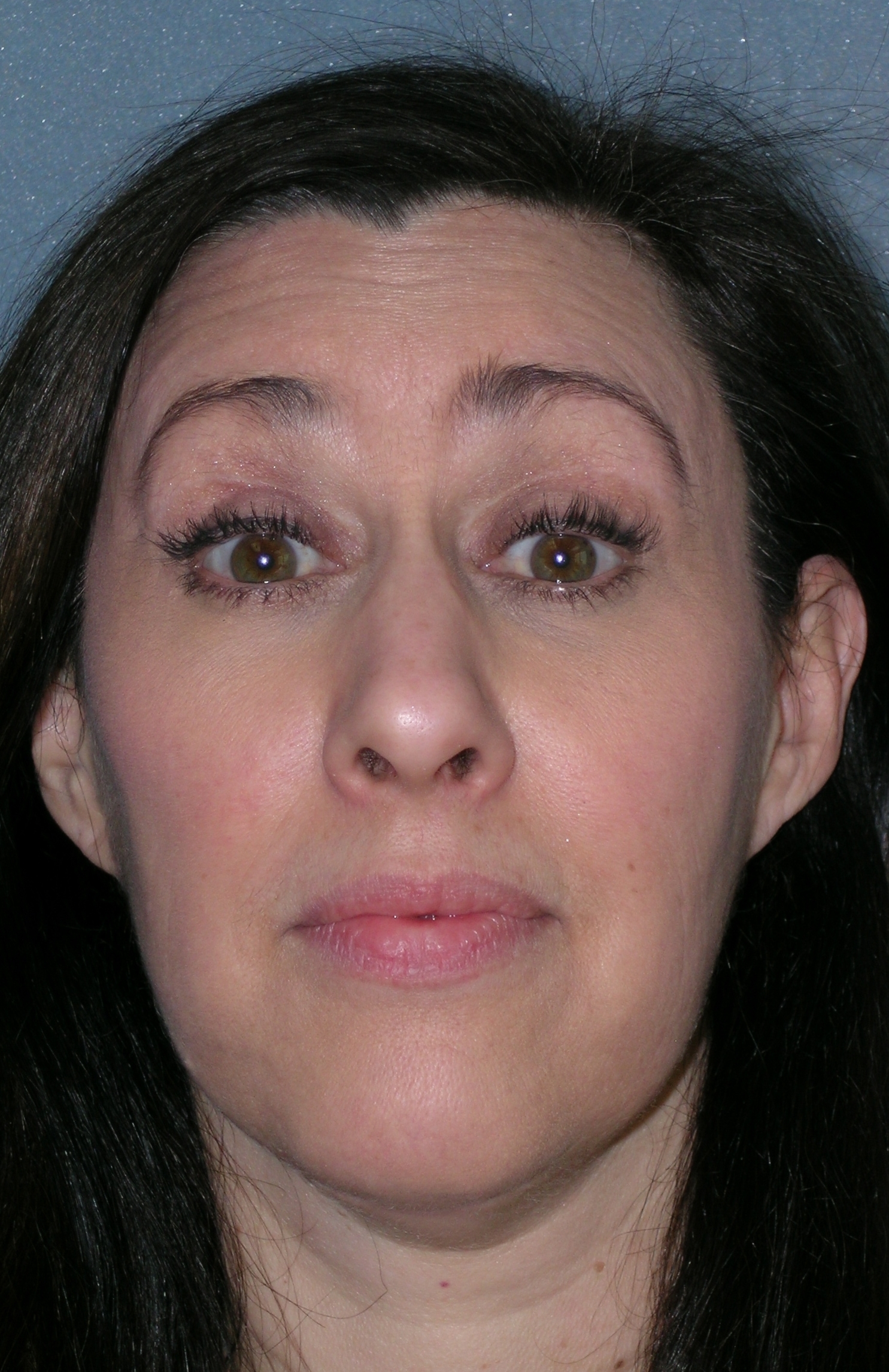 Botulinum Toxin Before and After Photos