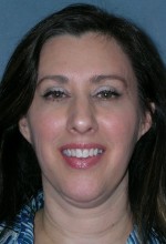 Botulinum Toxin