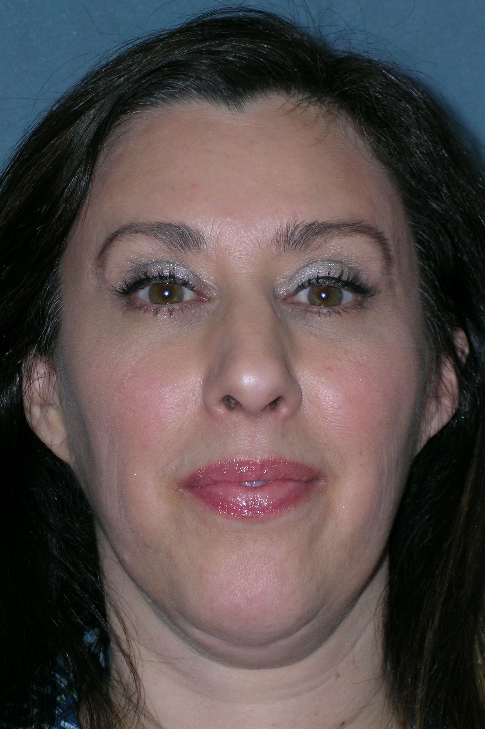 Botulinum Toxin Before and After Photos