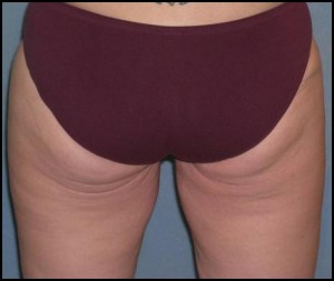 Thigh Lift Case 4196 After Photo Thigh Lift