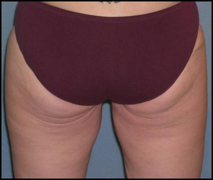 Thigh Lift Before and After Photos