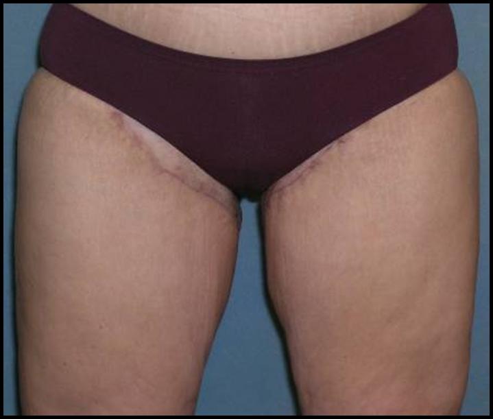 Thigh Lift Before and After Photos