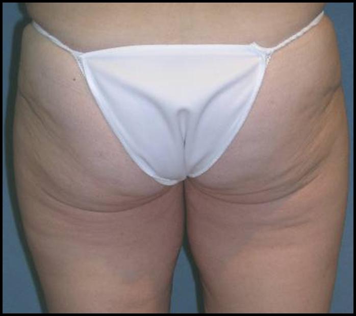 Thigh Lift Before and After Photos