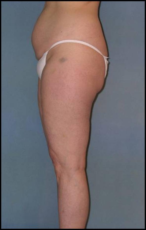 Thigh Lift Before and After Photos