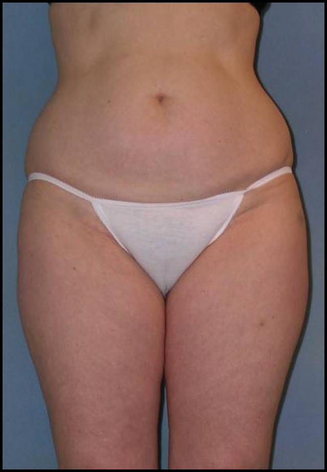 Thigh Lift Before and After Photos