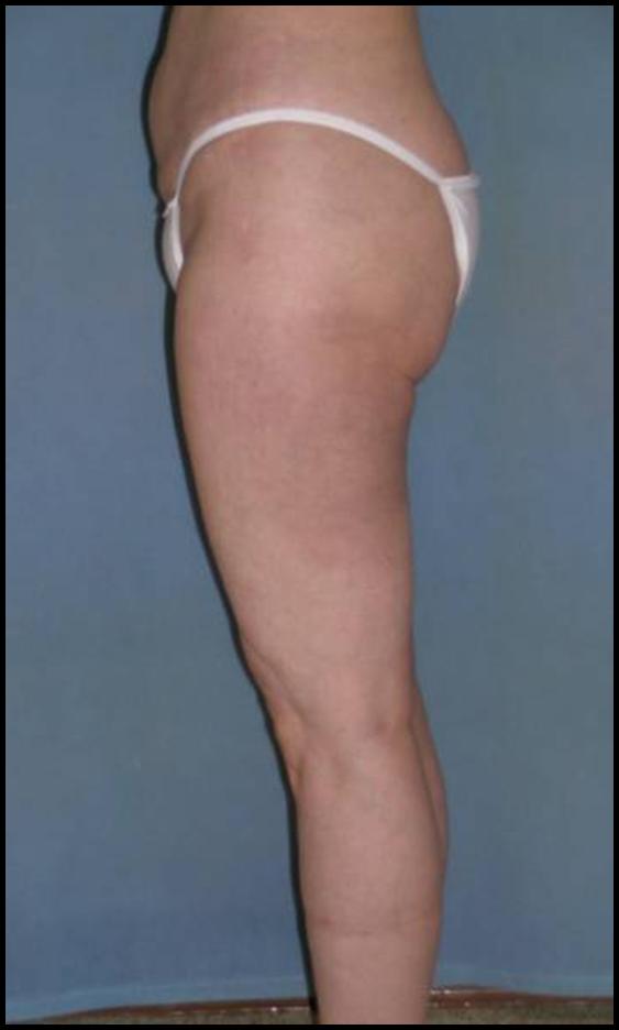 Thigh Lift Before and After Photos