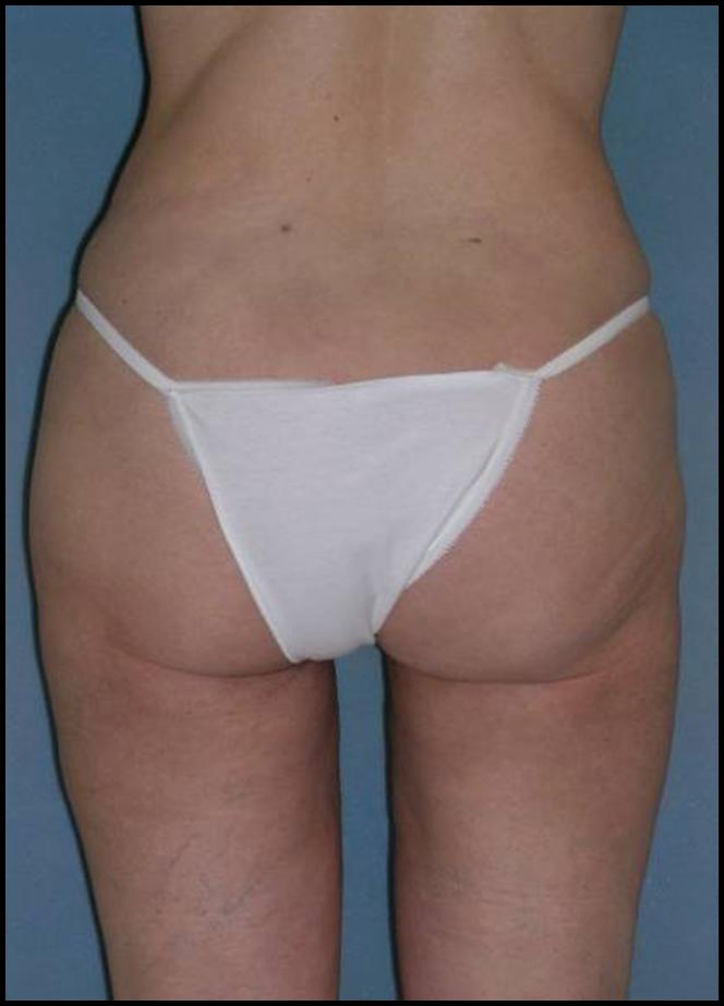 Thigh Lift Before and After Photos