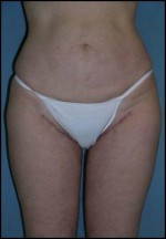 Thigh Lift