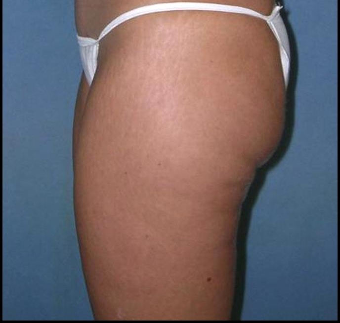 Thigh Lift Before and After Photos