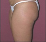Thigh Lift