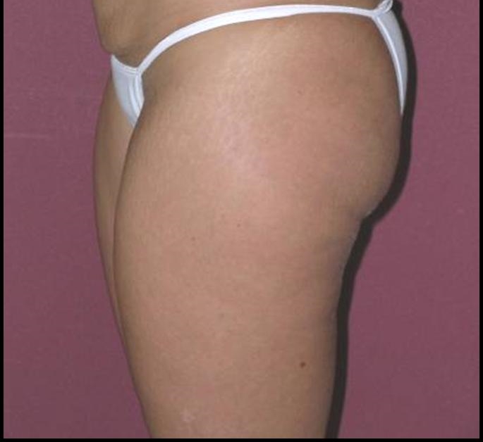 Thigh Lift Before and After Photos