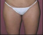 Thigh Lift