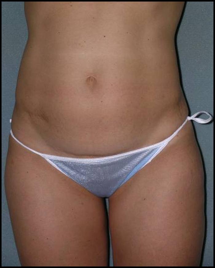 Tummy Tuck Before and After Photos