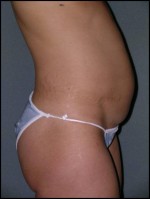 Tummy Tuck