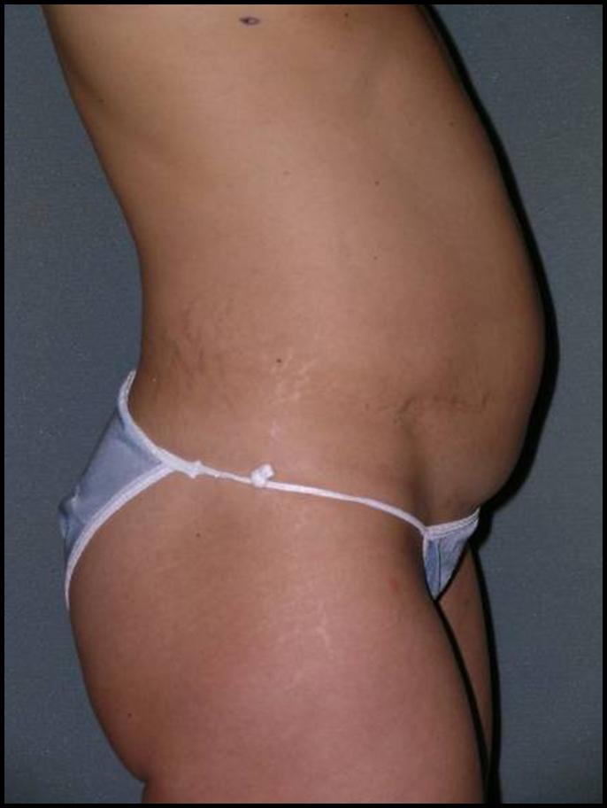 Before After Photos Tummy Tuck