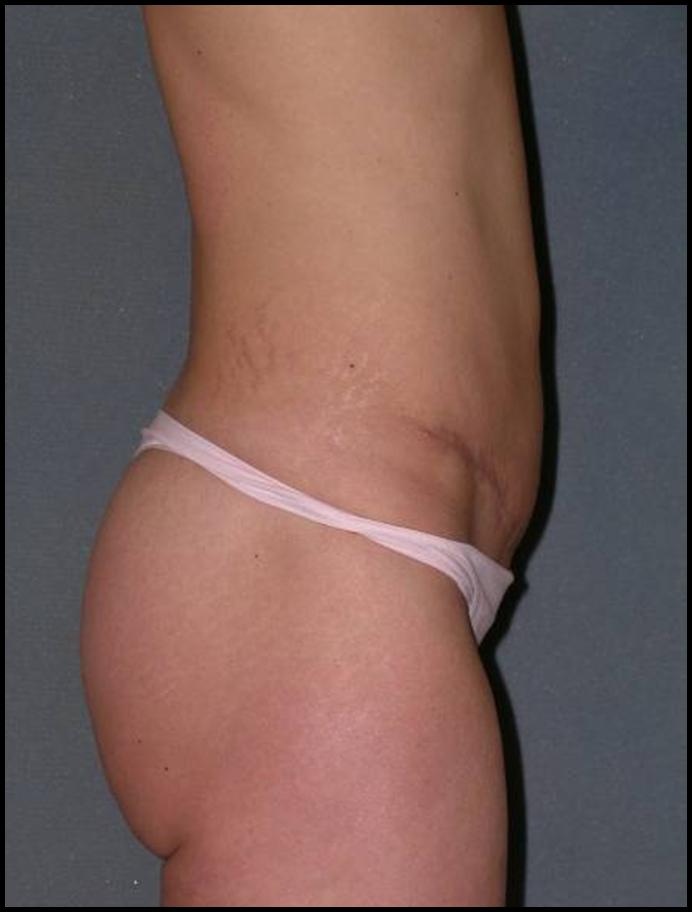 Before After Photos Tummy Tuck