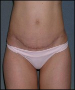 Tummy Tuck