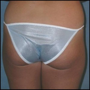 Thigh Lift