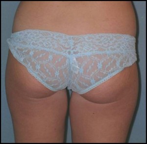 Thigh Lift