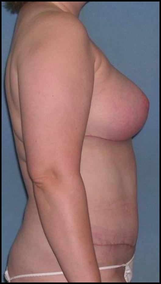 Breast and Abdomen Before and After Photos