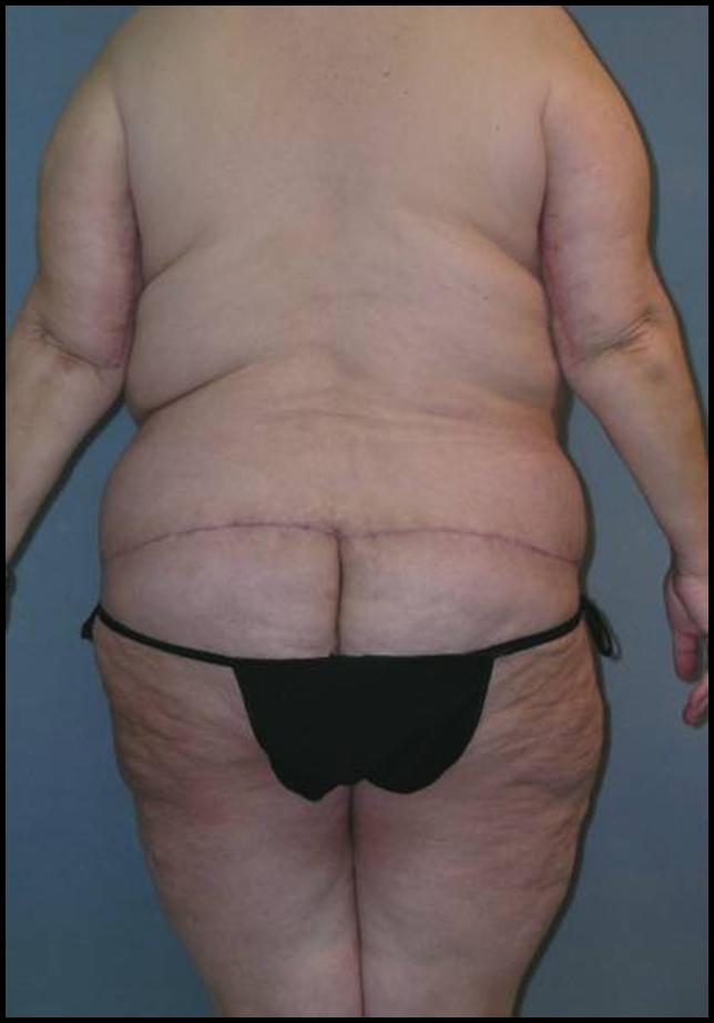 Before After Photos Belt Lipectomy