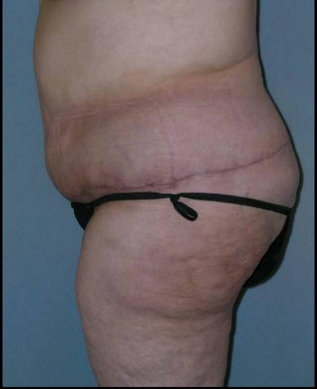 Before After Photos Belt Lipectomy