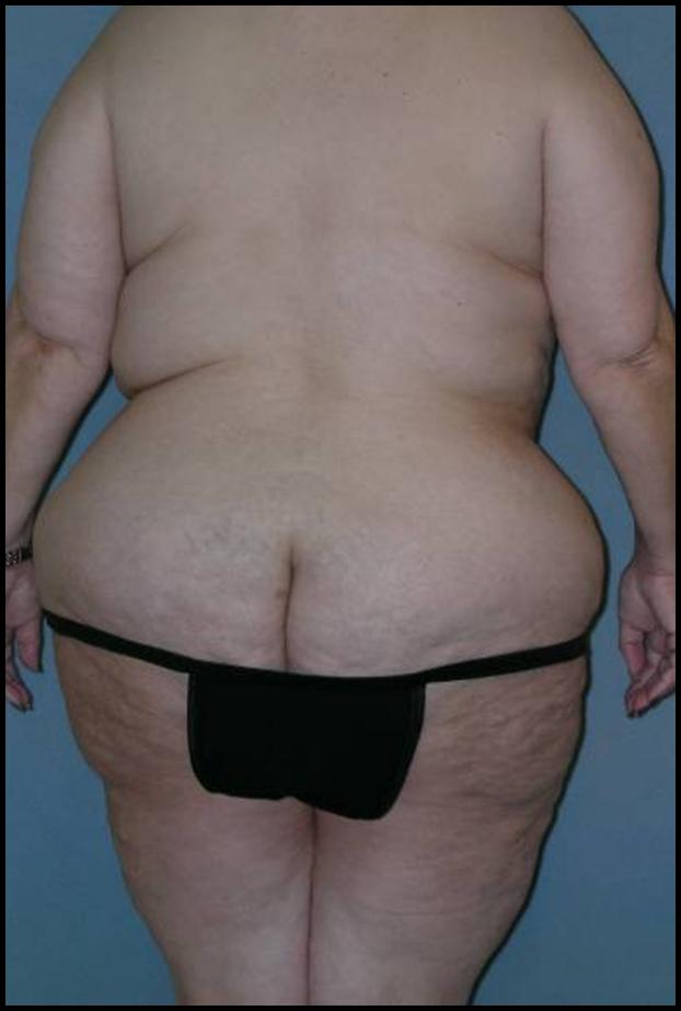 Before After Photos Belt Lipectomy