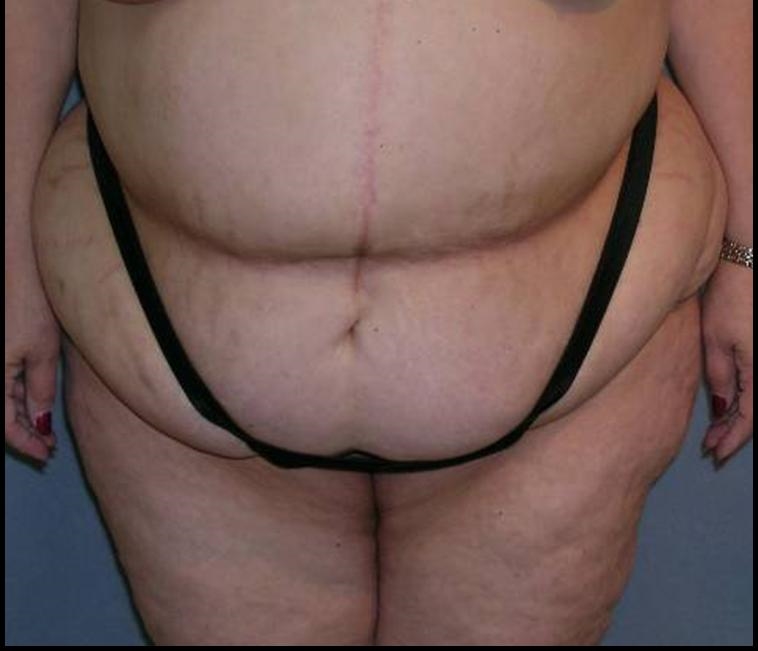 Before After Photos Belt Lipectomy