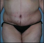 Belt Lipectomy