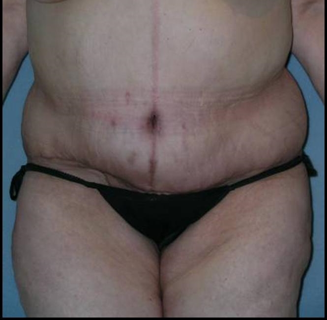 Before After Photos Belt Lipectomy