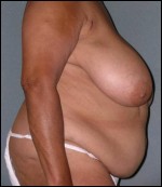 Body Lift