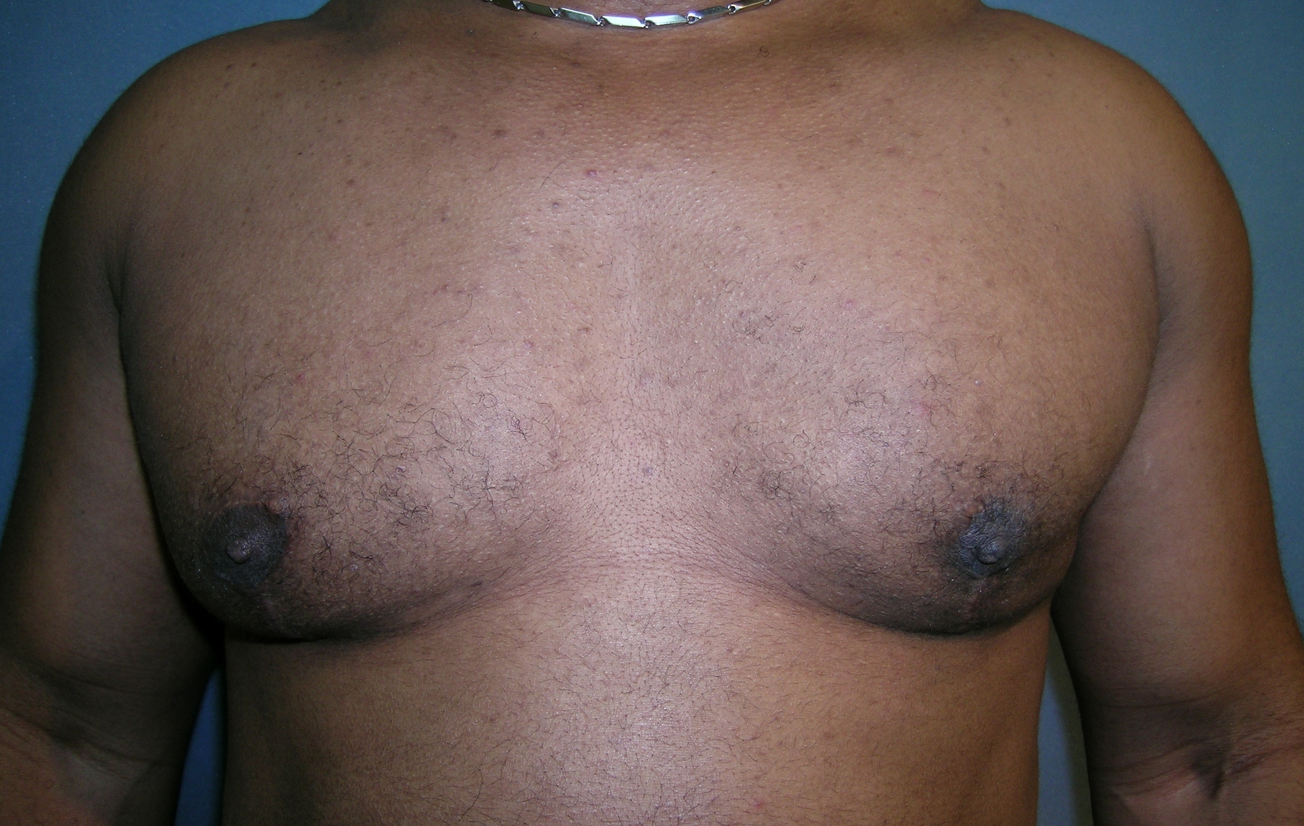 Male Breast Reduction Before and After Photos | Dr. Balakhani