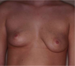 Mastopexy Augmentation