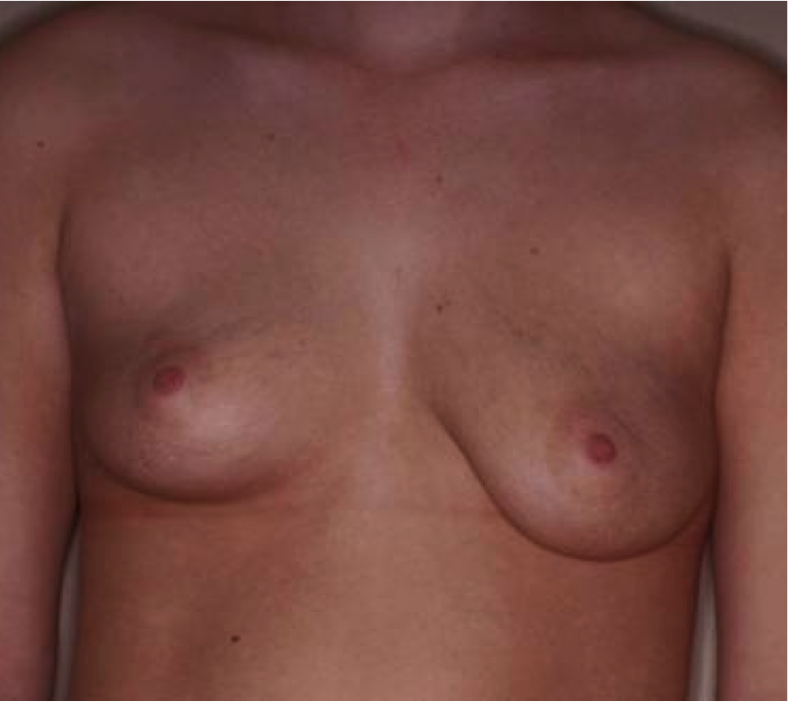 Mastopexy Augmentation Before and After Photos