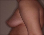Mastopexy Augmentation