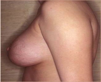 Mastopexy Augmentation Before and After Photos