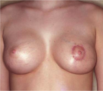 Mastopexy Augmentation