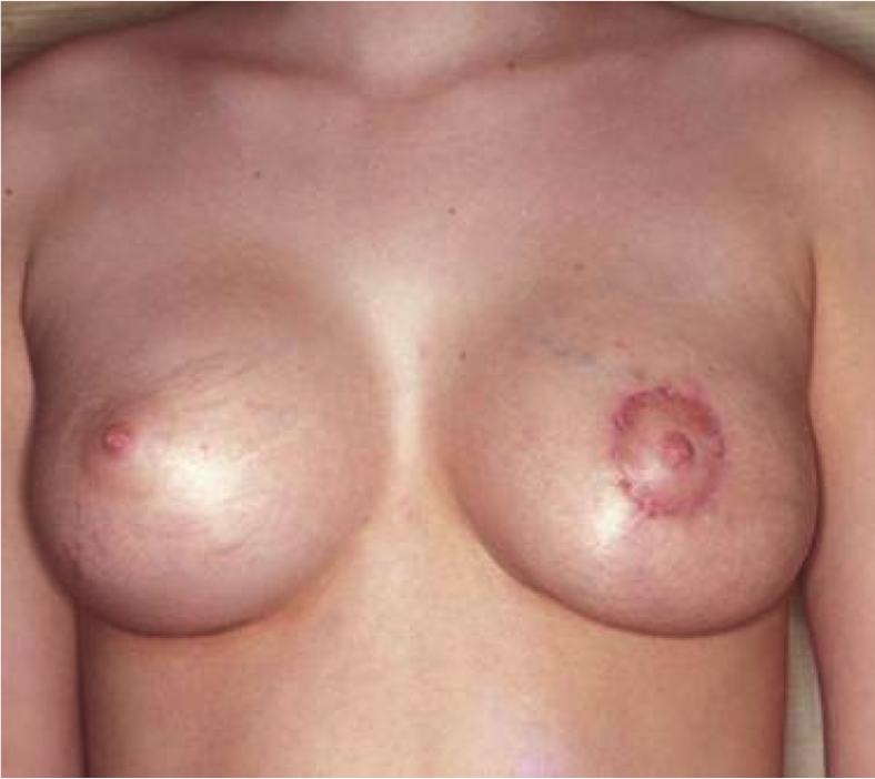 Mastopexy Augmentation Before and After Photos