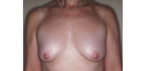 Mastopexy Augmentation Before and After Photos